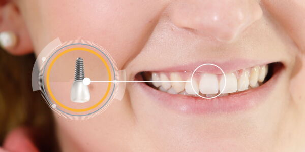 Implantologie in der Zahnarztpraxis Huth in Leipzig Implantologie in der Zahnarztpraxis Huth in Leipzig